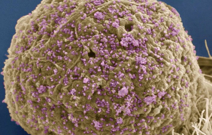 A colorized scanning electron micrograph depicts HIV particles (seen as purple spheres) infecting a cell in the immune system.