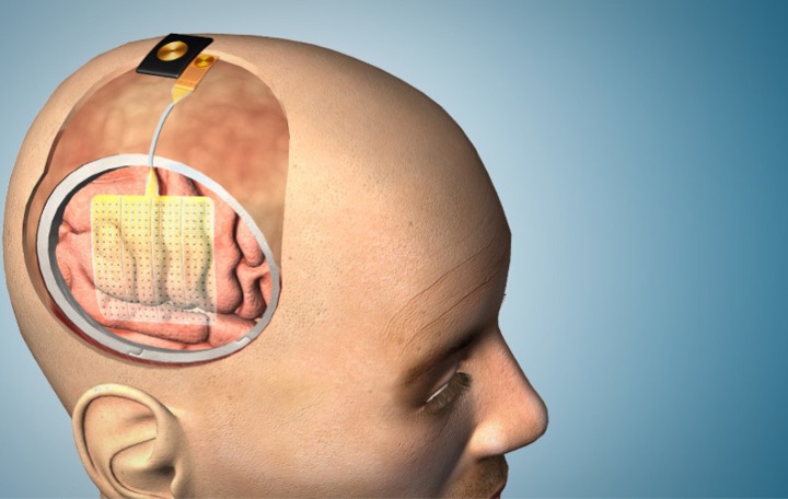 Rendered cross-section of human head showing electrode design and placement.